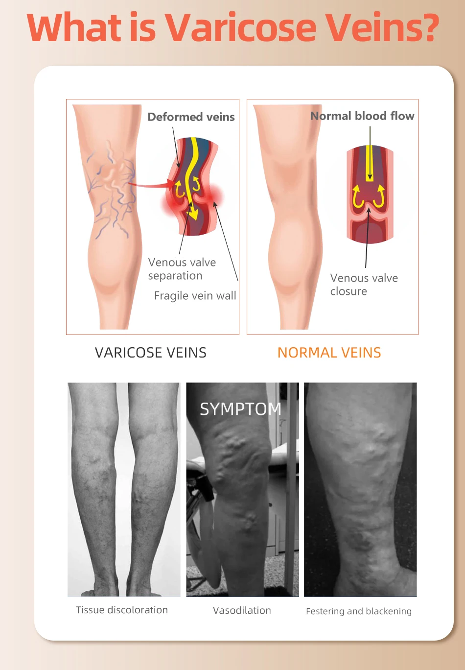 30-40mm Hg atas lutut kaki ter - Compression Sock Medical ulasan dan harga